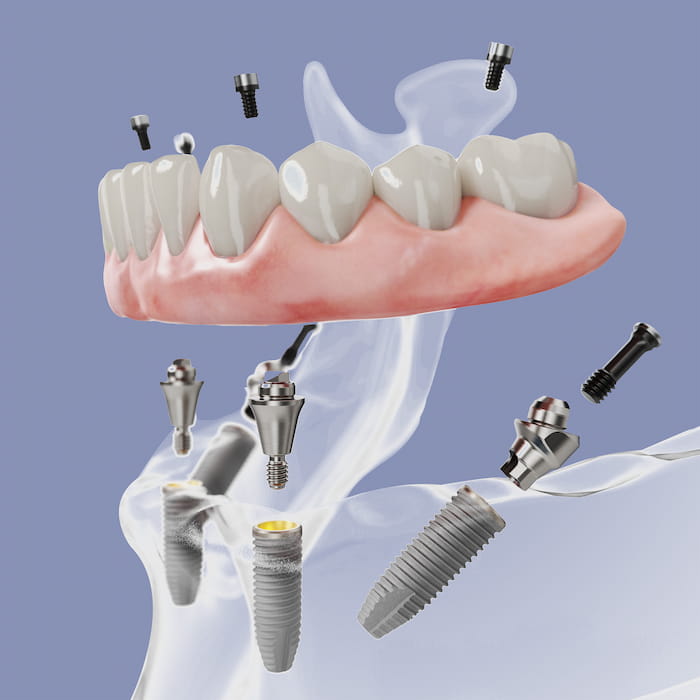 Im dritten Schritt der OP wird der provisorische Zahnersatz mit den soeben eingesetzen Implantaten verschraubt, noch in der gleichen Sitzung