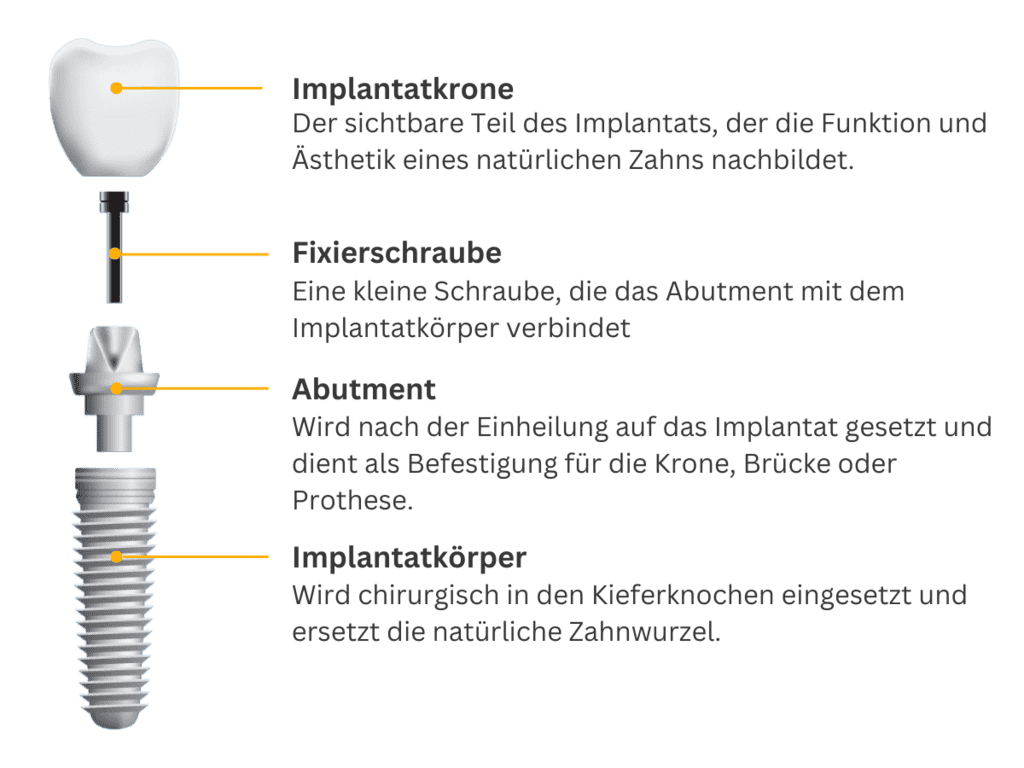 Aufbau eines Implantats – Mobile