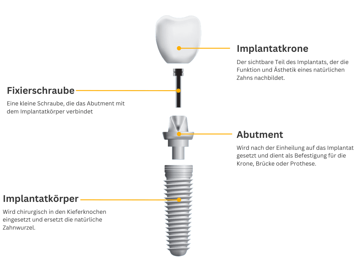 Implantat Aufbau