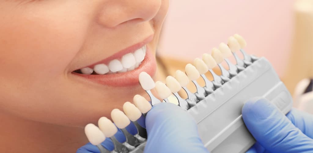 Anprobe von Veneers bei Carree Dental für den perfekten Weißton der Zähne